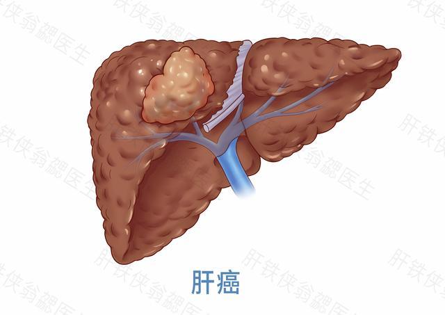 肝癌最早期三个月症状