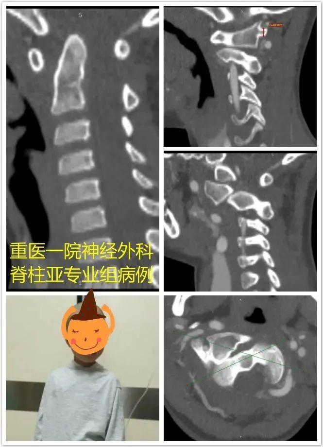 八个月的宝宝歪头，原因、影响与处理方法